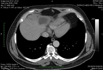 Компьютерная томография печени
