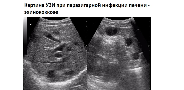 Картина УЗИ при паразитарной инфекции печени - эхинококкозе