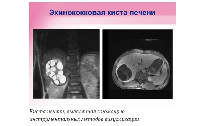 Киста печени