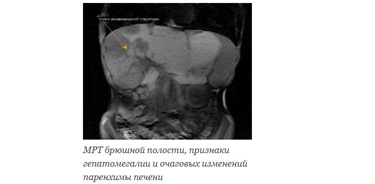МРТ брюшной полости