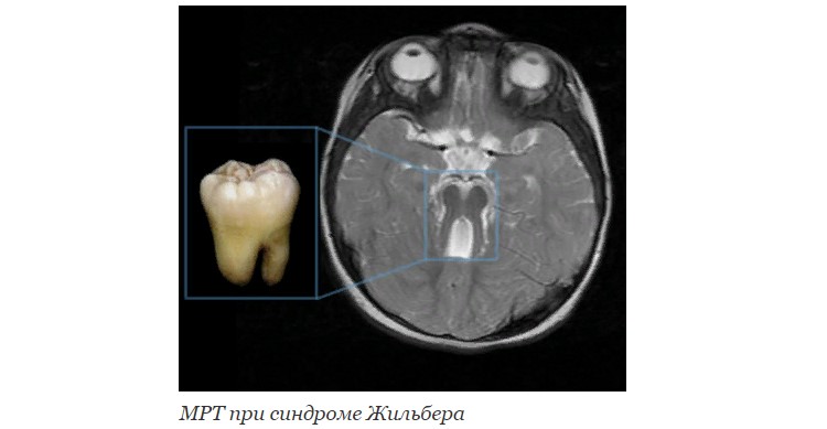 МРТ при синдроме Жильбера
