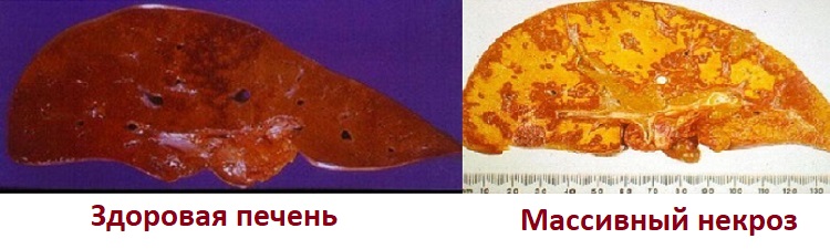 Массивный некроз