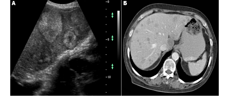 Метастазы в печени на УЗИ и КТ