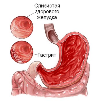 Обострение хронического гастродуоденита Обострение хронического гастродуоденита