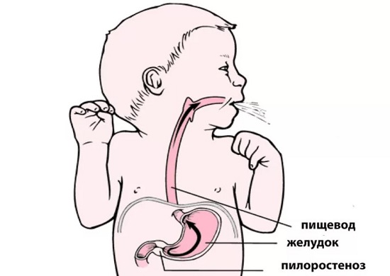 Пилороспазм у детей