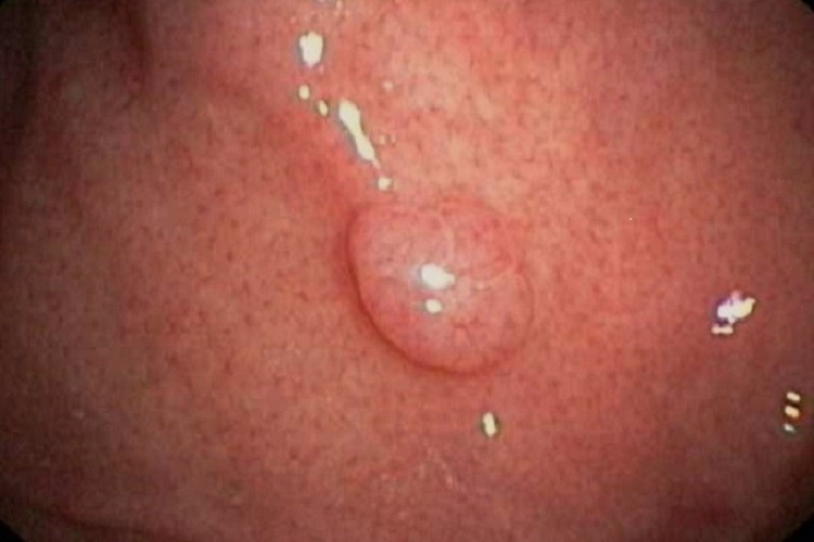 Гиперпластический полип это самое частое полиповидное образование желудка Гиперпластический полип