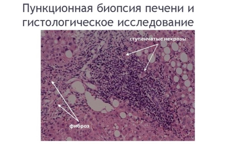 Препарат паренхимы печени при микроскопии материала пациента с аутоиммунным гепатитом