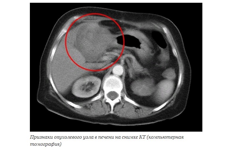 Признаки опухолевого узла в печени
