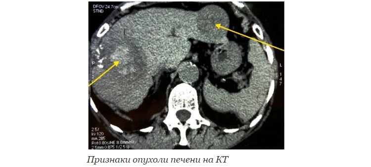 Признаки опухоли печени на КТ