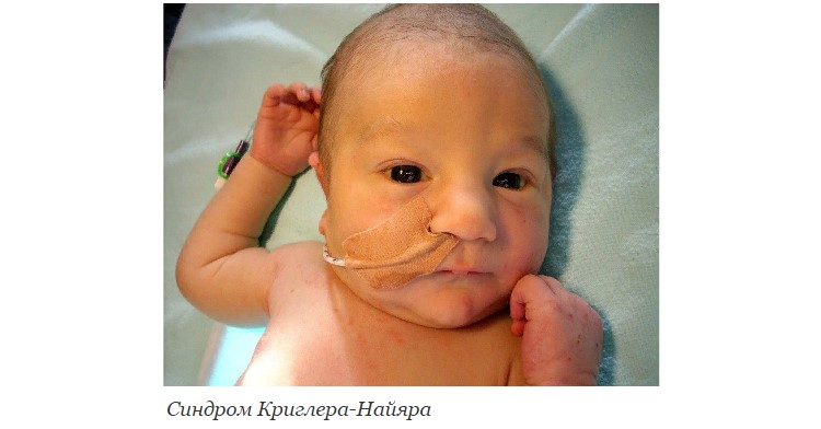 Синдром Криглера-Найяра