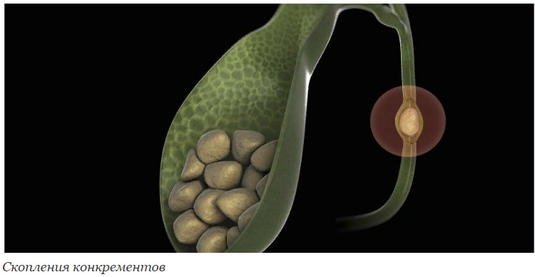 Скопления конкрементов