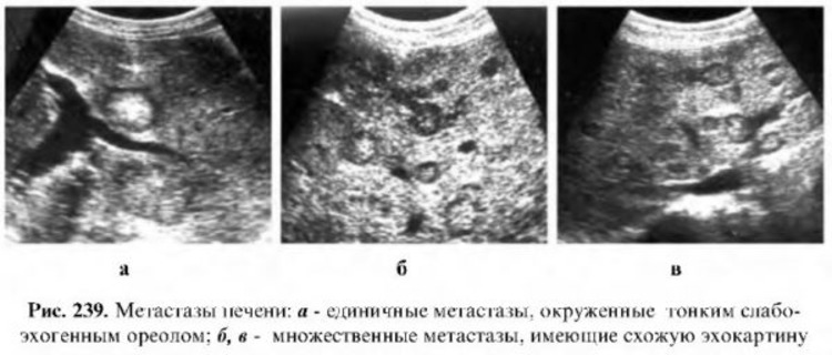 УЗИ-картина единичных и множественных метастазов в печени