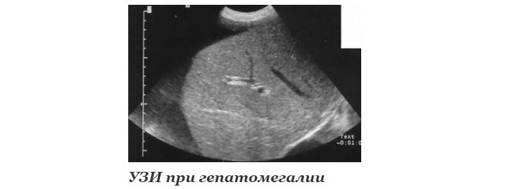 УЗИ при гепатомегалии