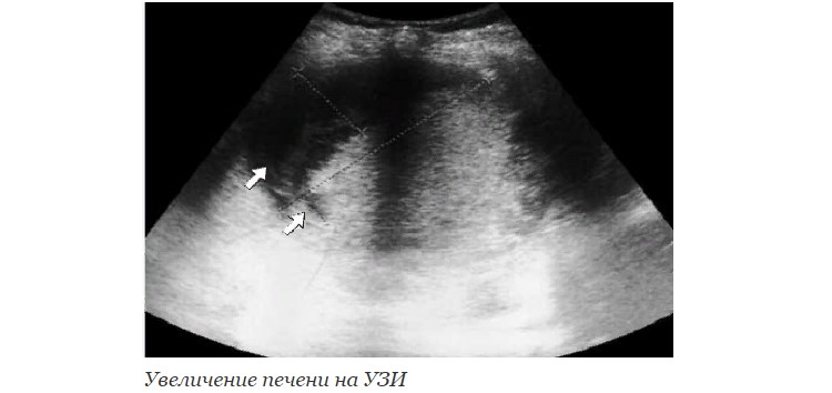 Увеличение печени на УЗИ