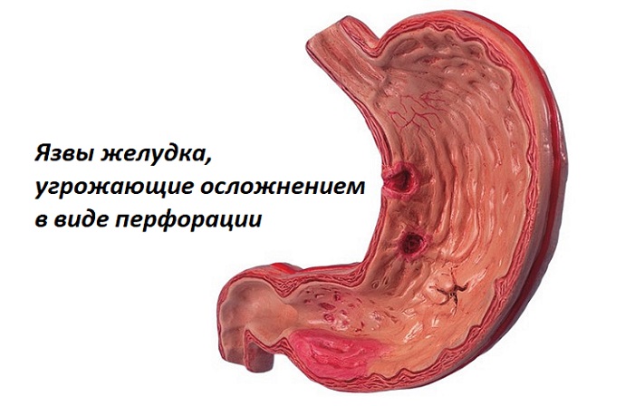 Язвы желудка, угрожающие осложнением в виде перфорации