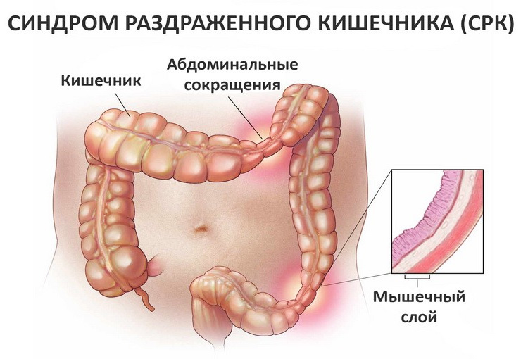 Активированный уголь назначают при вздутии на фоне СРК СРК