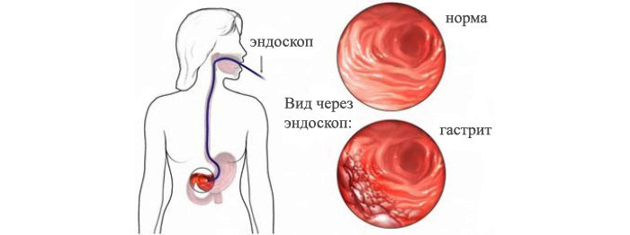 Эндоскопия желудка при эрозивном гастрите Эндоскопия