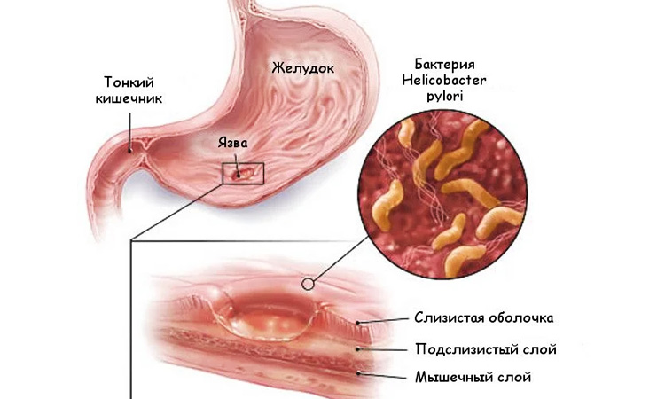 Бактерия провоцирующая воспаление внутреннего слоя желудка Helicobacter pylori
