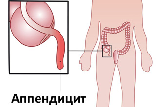 Аппендицит Аппендицит
