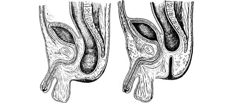 Полная и свищевая форма атрезии Полная и свищевая форма атрезии