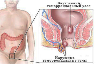 Существует две формы болезни Существует две формы болезни