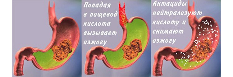 Механизм действия антацидов Механизм действия антацидов