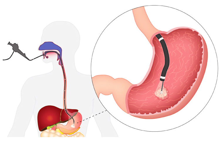 ФГДС с биопсией ФГДС с биопсией