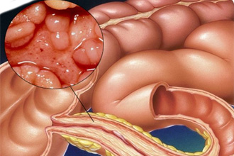 Болезнь Крона Болезнь Крона