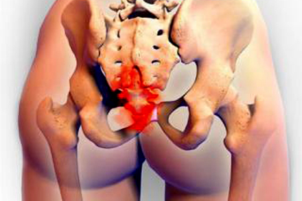 Боли в копчике Защемление нервных окончаний в копчике