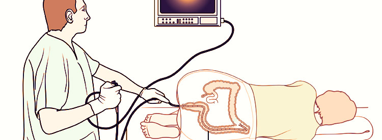 Колоноскопия воздействует на кишечник, поэтому необходимо восстановление