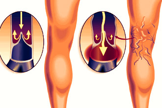 Что такое варикоз