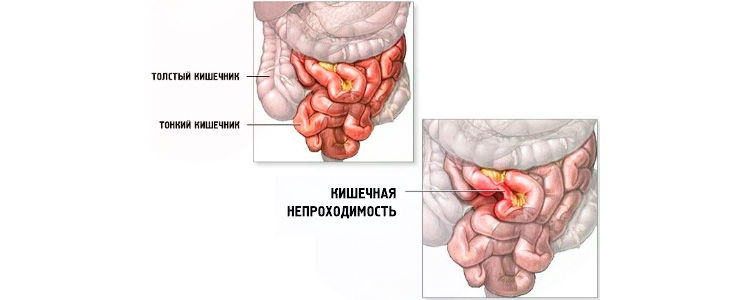 Непроходимость кишечника Кишечная непроходимость