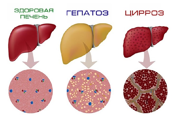 Диффузные изменения печени