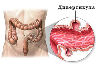 Дивертикул кишечника Дивертикул кишечника