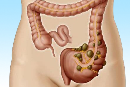 Дивертикулез толстой кишки Образование дивертикулей