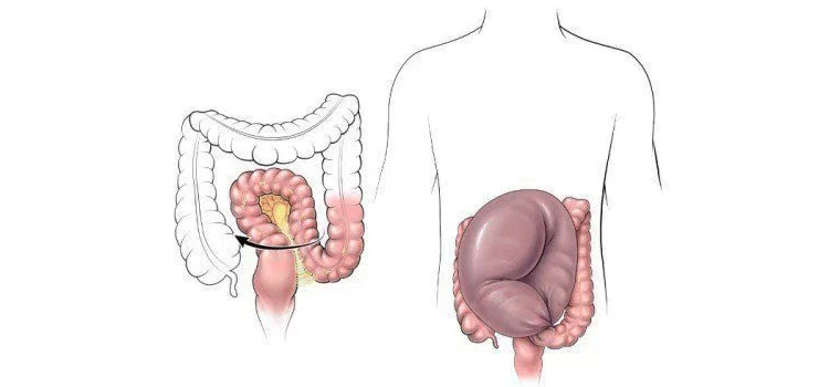 Долихосигма Долихосигма