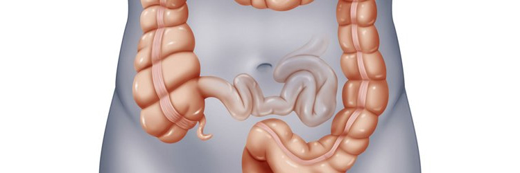 Долихоколон Долихоколон