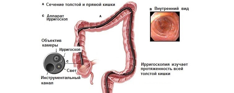 Ирригоскопия Ирригоскопия