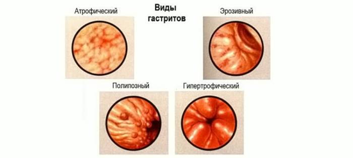 Каким бывает гастрит? Виды гастритов