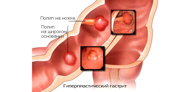 Полипы при гиперпластическом гастрите Гиперпластический гастрит