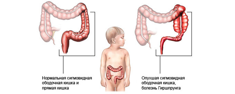 Болезнь Гиршпрунга у детей Болезнь Гиршпрунга у детей