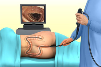 Колоноскопия Колоноскопия