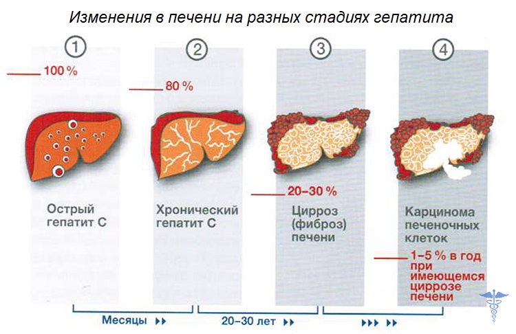 изменения в печени на разных стадиях гепатита