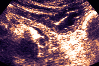 Проведение эхографии желудка Эхография желудка