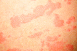 Аллергия при использовании пластыря китайского от геморроя