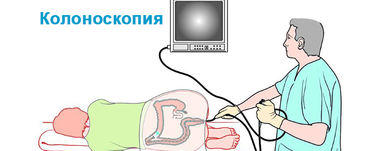 Проведение колноскопии Проведение колноскопии