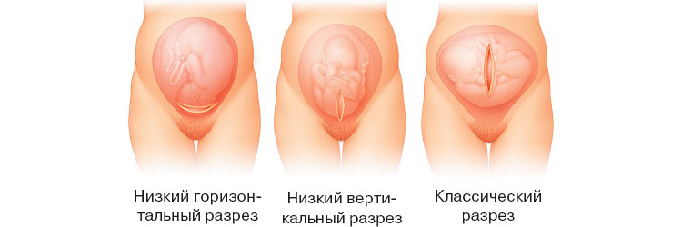 Кесарево сечение Кесарево