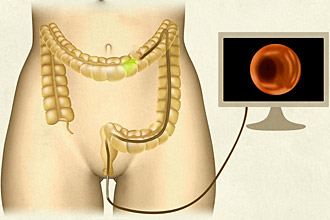 Метод колоноскопии