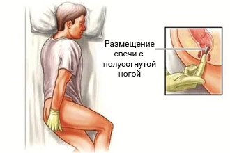 Как вводить ректальные свечи