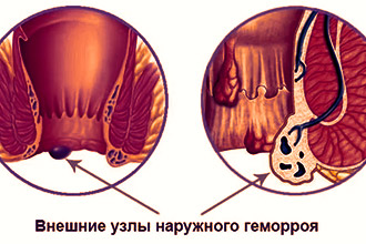 Геморрой - болезнь при которой нужны свечи метилурацила